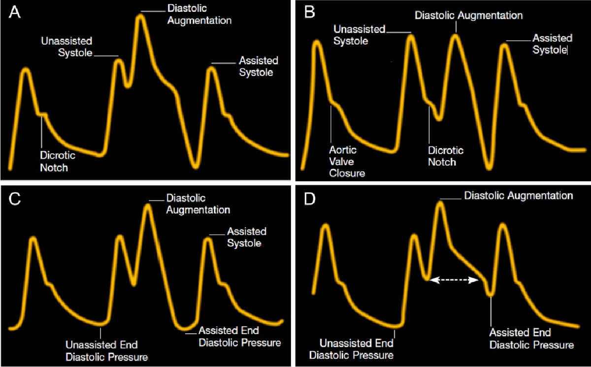 Figure 4 From Management Of Intra Aortic Balloon Pumps Semantic Scholar Figure 4 From Management Of Intra Aortic Balloon Pumps Semantic Scholar