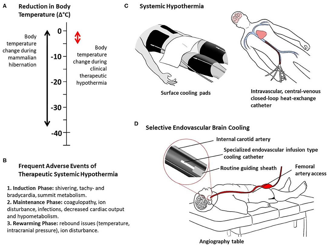Frontiers Selective Brain Hypothermia In Acute Ischemic Stroke Reperfusion Without Reperfusion Injury