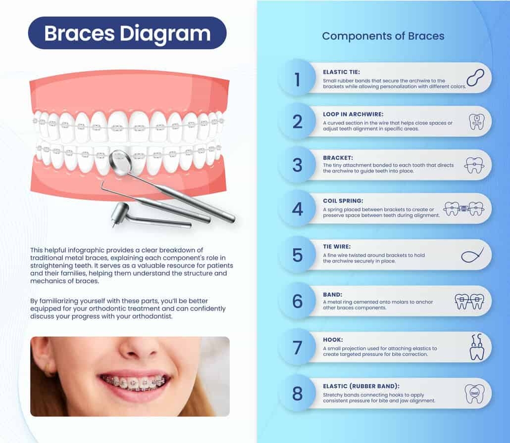 Our Full Braces Diagram More Fowler Orthodontics Our Full Braces Diagram More Fowler Orthodontics
